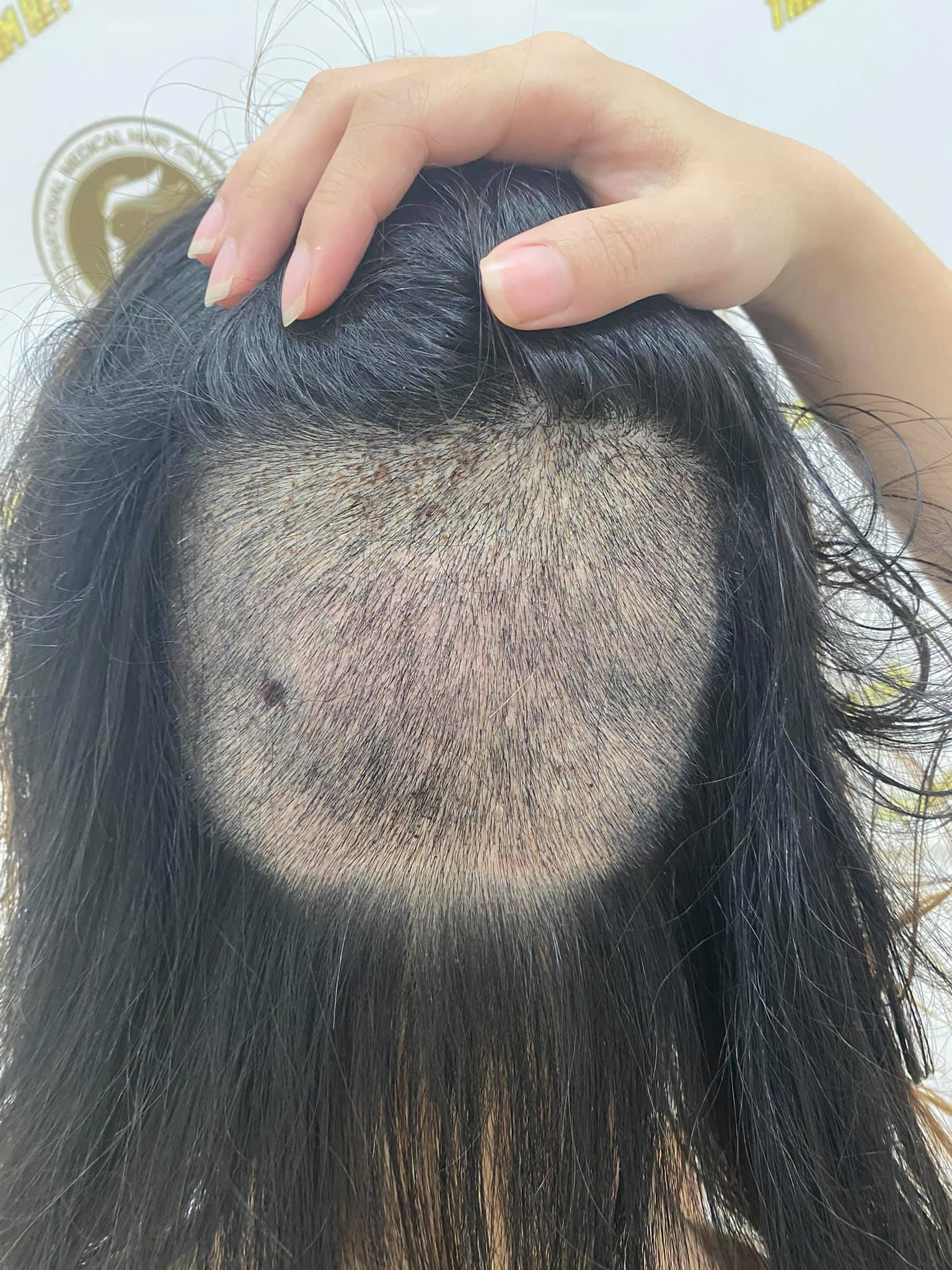 Chi 90 triệu để cấy 2cm tóc trị trán dô: Từng bất an cực độ vì tóc rụng lả tả, nhưng vài tháng sau lại cho kết quả mê ly không ngờ - Ảnh 3.