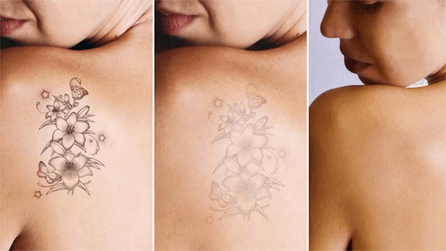Xóa xăm bằng laser: Từ cách xóa đến biến chứng dễ gặp đều được chuyên gia giải đáp - Ảnh 5. Xóa xăm bằng laser: Từ cách xóa đến biến chứng dễ gặp đều được chuyên gia giải đáp - Ảnh 5.