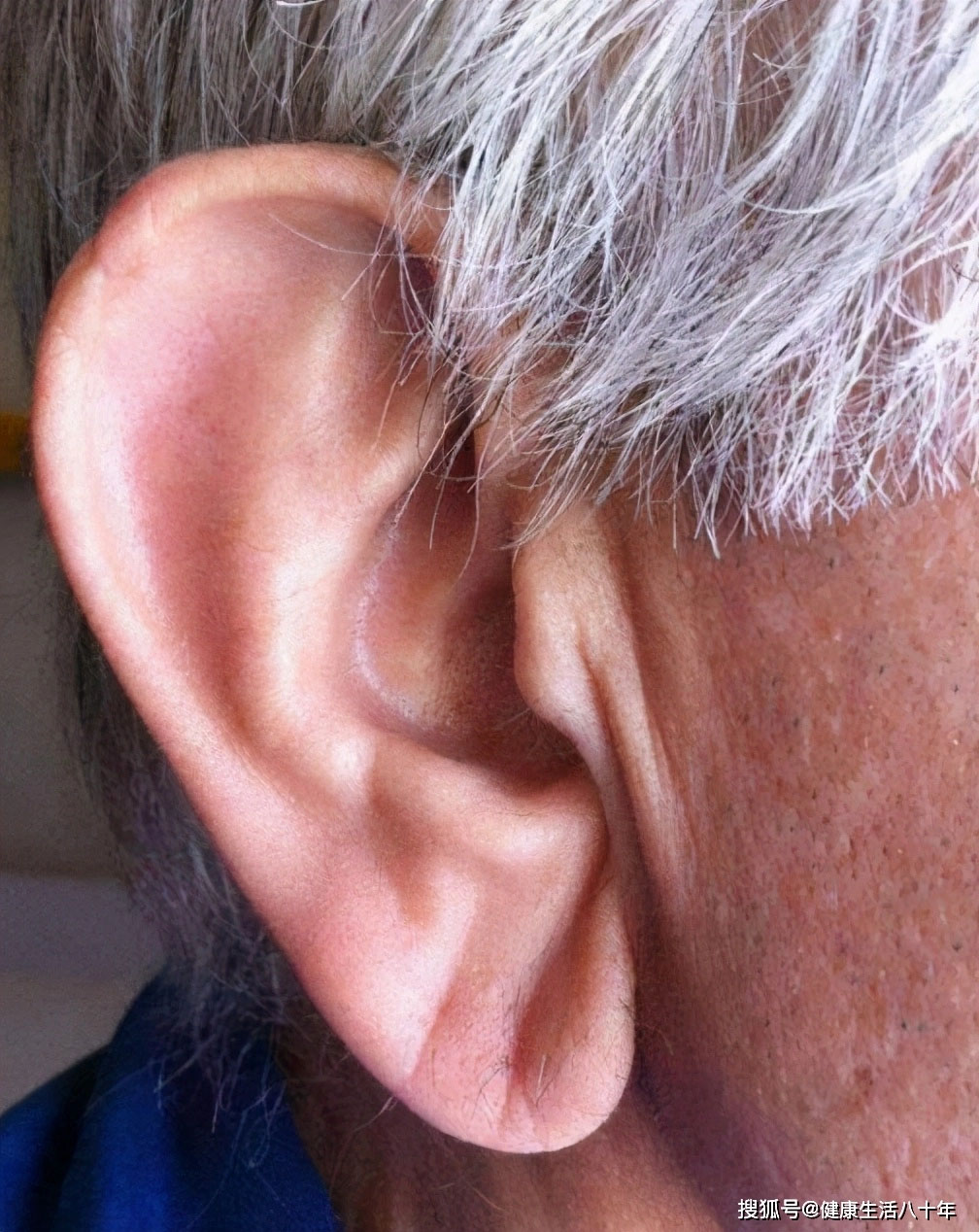 Диагональная складка на мочке уха