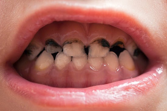 Nếu mặc kệ sâu răng và chờ rụng thay răng mới, trẻ sẽ gánh hậu quả gì? - Ảnh 15.