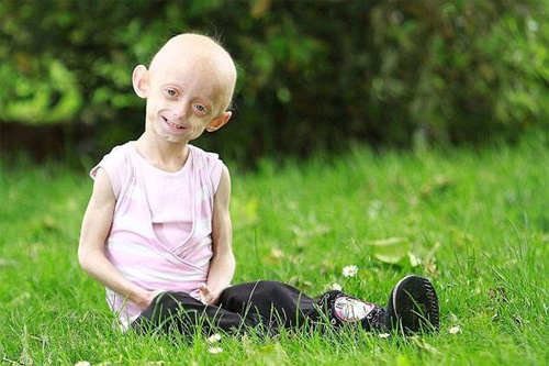 Hội chứng Progeria: Giải mã bí ẩn của những đứa trẻ “già sớm” - Ảnh 1.