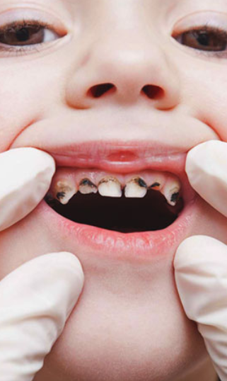 Ngoài chiều cao, thể chất, sức khỏe răng miệng cũng là vấn đề bố mẹ đặc biệt cần quan tâm để con lớn lên mạnh khỏe - Ảnh 4. Ngoài chiều cao, thể chất, sức khỏe răng miệng cũng là vấn đề bố mẹ đặc biệt cần quan tâm để con lớn lên mạnh khỏe - Ảnh 4.