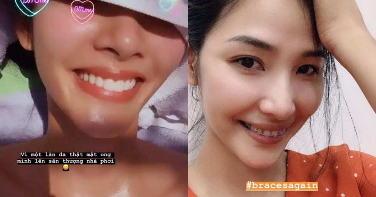 Đâu phải sinh ra đã đẹp, đến Khánh Vân phải chịu khó niềng răng mới hoàn hảo như bây giờ đấy - Ảnh 4. Đâu phải sinh ra đã đẹp, đến Khánh Vân phải chịu khó niềng răng mới hoàn hảo như bây giờ đấy - Ảnh 4.