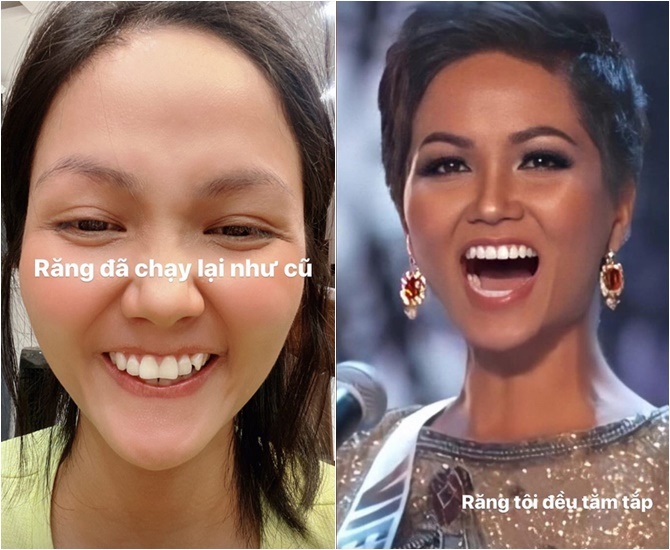 Đâu phải sinh ra đã đẹp, đến Khánh Vân phải chịu khó niềng răng mới hoàn hảo như bây giờ đấy - Ảnh 5. Đâu phải sinh ra đã đẹp, đến Khánh Vân phải chịu khó niềng răng mới hoàn hảo như bây giờ đấy - Ảnh 5.
