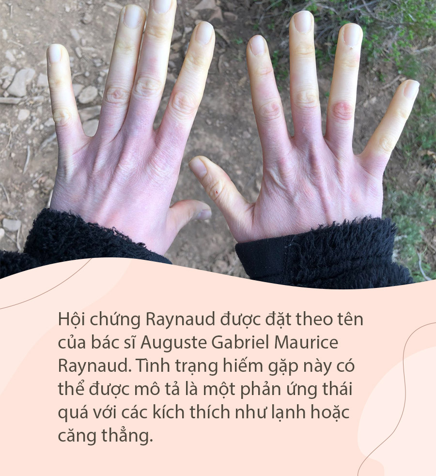 Hội chứng Raynaud - Hãy tìm hiểu về hội chứng Raynaud và cách điều trị giúp bạn giữ ấm cho đôi tay của mình trong mùa đông lạnh giá.