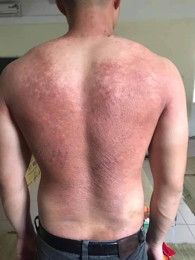 Hình ảnh tấm lưng phồng rộp của bác sĩ nơi tâm dịch Bắc Giang khiến nhiều người nghẹn ngào - Ảnh 2. Hình ảnh tấm lưng phồng rộp của bác sĩ nơi tâm dịch Bắc Giang khiến nhiều người nghẹn ngào - Ảnh 2.