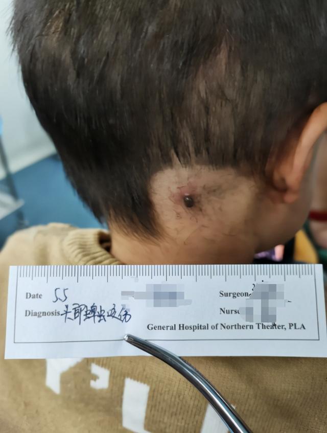Con trai nói ngứa đầu, gia đình phát hiện sau gáy bé có "cục thịt dư", 3 hành động dứt khoát của người mẹ được bác sĩ khen ngợi - Ảnh 1. Con trai nói ngứa đầu, gia đình phát hiện sau gáy bé có "cục thịt dư", 3 hành động dứt khoát của người mẹ được bác sĩ khen ngợi - Ảnh 1.