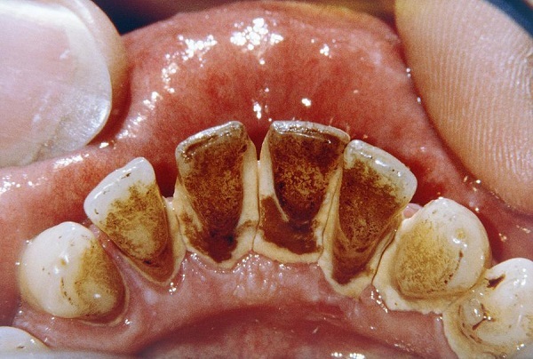 Chuyên gia chỉ ra &quot;nút chặn&quot; virus xâm nhập răng miệng ở bệnh nhân Covid-19, trong mùa dịch người dân càng nên dắt túi phòng ngừa - Ảnh 8.