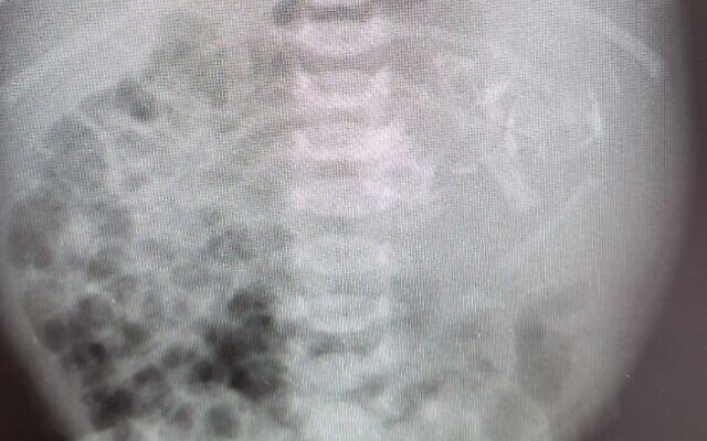 Vừa chào đời, bụng của bé gái đã to bất thường, bác sĩ &quot;kinh hoàng&quot; khi xem kết quả X-quang, lúc phẫu thuật lại càng choáng váng - Ảnh 1.