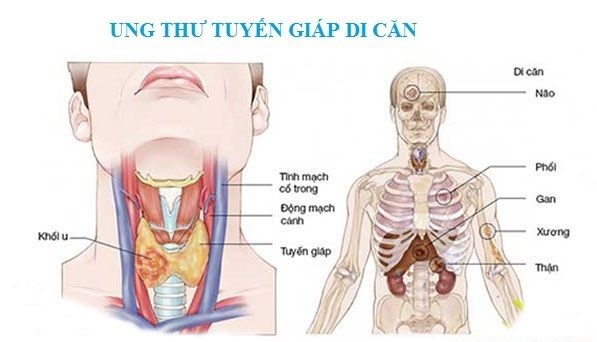 Ung thư tuyến giáp di căn sau 16 năm được cứu sống ngoạn mục - Ảnh 3.