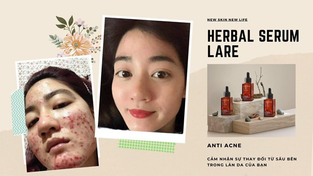 Lựa chọn từ thiên nhiên giúp phục hồi làn da hư tổn vì mụn - Ảnh 8.