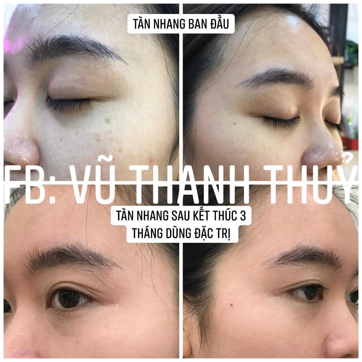 Bị tàn nhang do không bôi kem chống nắng đầy đủ, gái xinh quyết tâm phục thù và lấy lại làn da không tì vết sau hơn 3 tháng kiên trì - Ảnh 9.