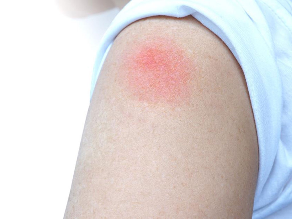“Cánh tay COVID-19” sau tiêm vaccine Moderna - Ảnh 3. “Cánh tay COVID-19” sau tiêm vaccine Moderna - Ảnh 3.
