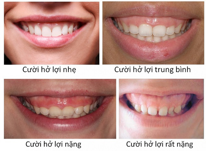 Mỹ nhân Cbiz và những hàm răng minh chứng cho câu: 1 nụ cười bằng 10 thang thuốc... nổ - Ảnh 12.