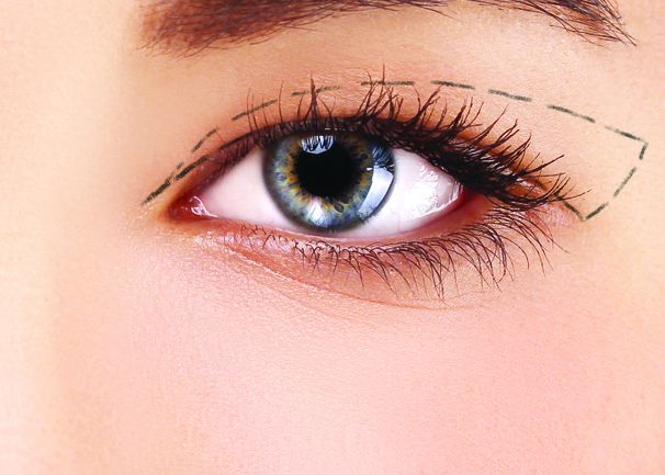 Cắt mắt 2 mí đẹp tự nhiên: Chuyên gia tiết lộ từ quy trình đến lưu ý để mắt đẹp sâu hút hồn - Ảnh 4.