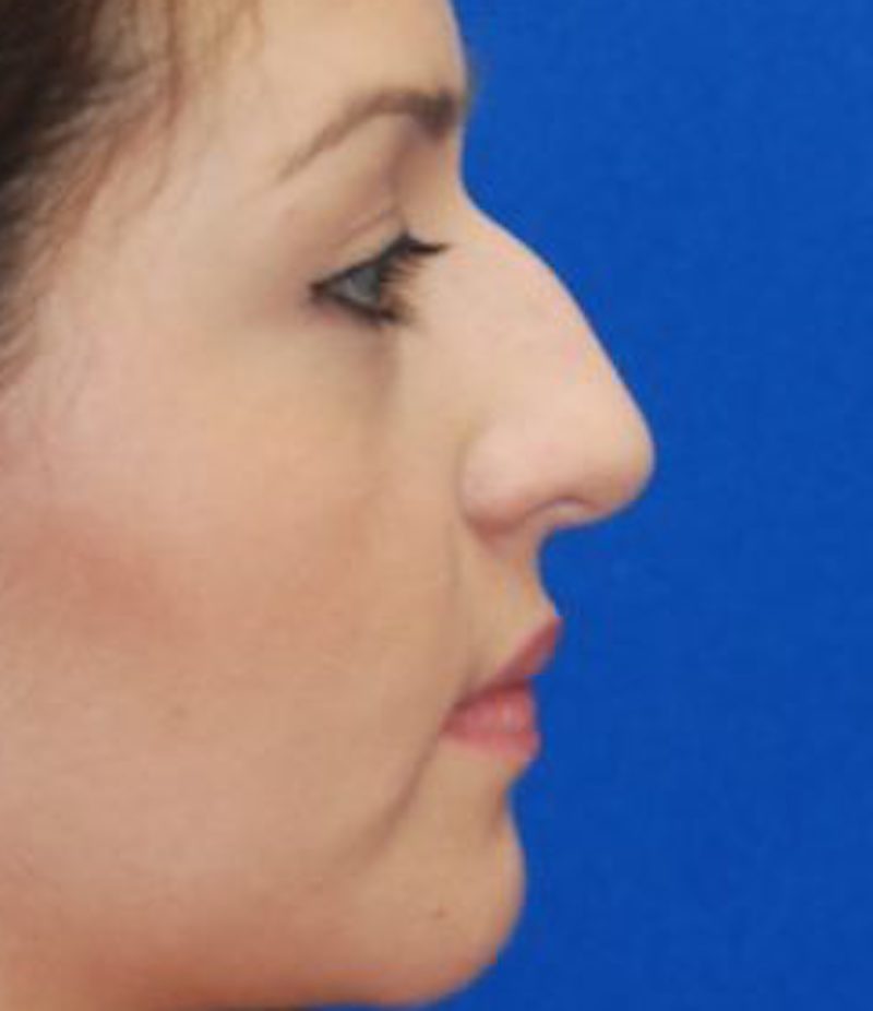 Mũi t&ocirc;i bị gồ th&igrave; cần chỉnh sửa những g&igrave; để sở hữu mũi đẹp, thanh t&uacute;? - Ảnh 2.