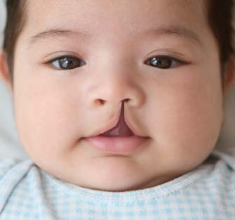 Phẫu thuật sứt môi, hở hàm ếch: Từ lưu ý đến giá cả, nơi nên thực hiện được chuyên gia chia sẻ tường tận - Ảnh 9. Phẫu thuật sứt môi, hở hàm ếch: Từ lưu ý đến giá cả, nơi nên thực hiện được chuyên gia chia sẻ tường tận - Ảnh 9.