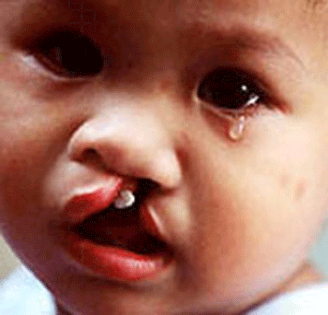 Phẫu thuật sứt môi, hở hàm ếch: Từ lưu ý đến giá cả, nơi nên thực hiện được chuyên gia chia sẻ tường tận - Ảnh 5. Phẫu thuật sứt môi, hở hàm ếch: Từ lưu ý đến giá cả, nơi nên thực hiện được chuyên gia chia sẻ tường tận - Ảnh 5.