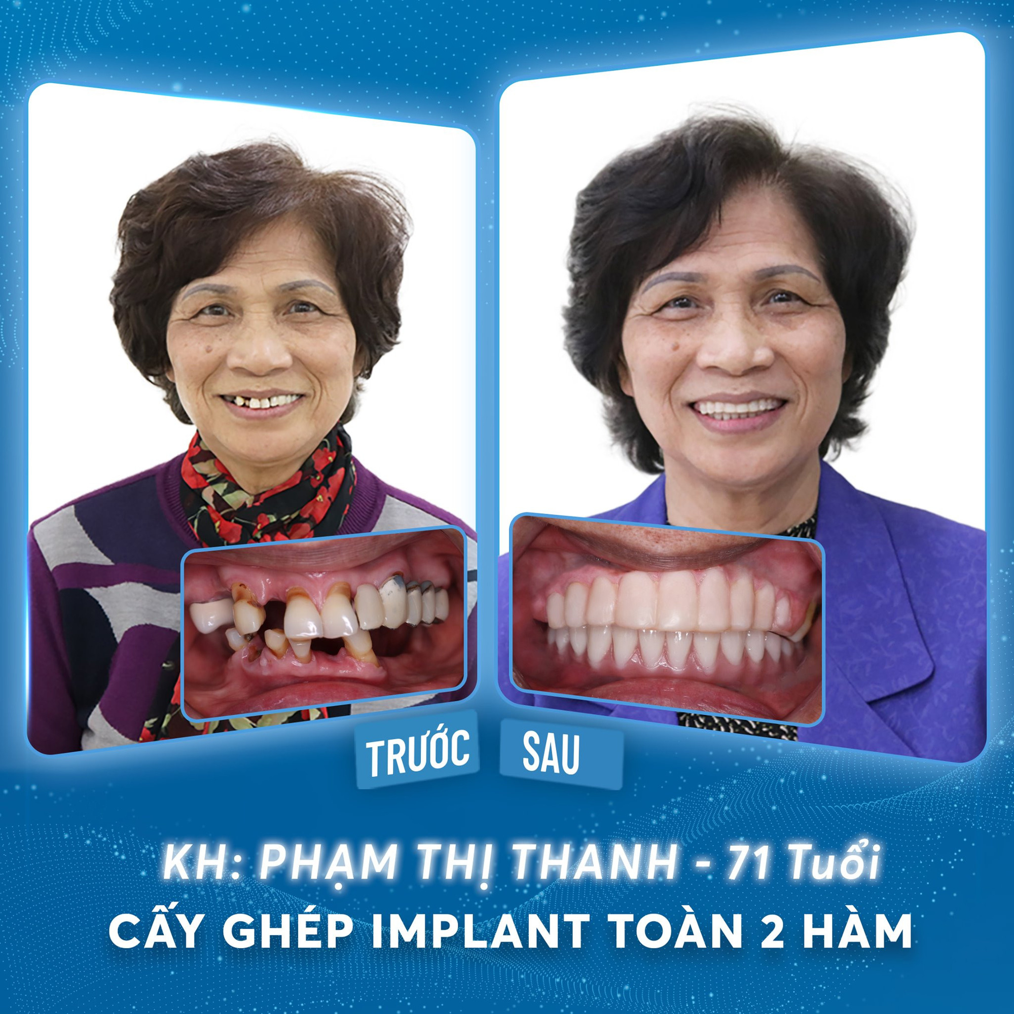 Trồng răng Implant cho răng chắc khỏe, vui Tết sum vầy - Ảnh 2.