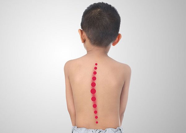 Cong vẹo cột sống ở trẻ em: Nguyên nhân, triệu chứng và cách phòng ngừa - Ảnh 2.