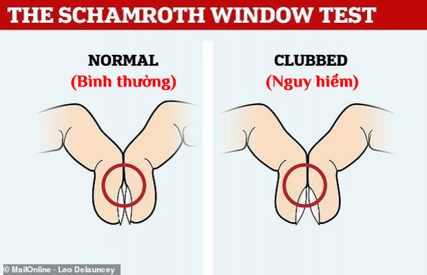 Một hành động tưởng vô nghĩa nhưng lại giúp bạn nhận biết nguy cơ mắc ung thư phổi từ sớm, không tin làm thử ngay! - Ảnh 2. Một hành động tưởng vô nghĩa nhưng lại giúp bạn nhận biết nguy cơ mắc ung thư phổi từ sớm, không tin làm thử ngay! - Ảnh 2.