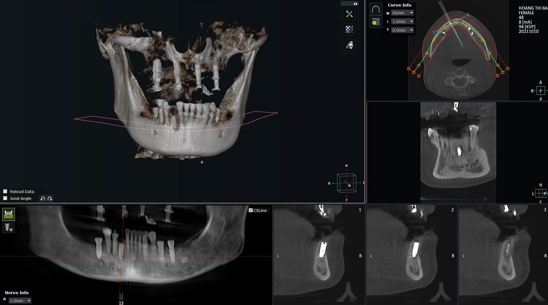 20 năm mất răng và hành trình tìm lại hạnh phúc nhờ trồng răng Implant - Ảnh 1. 20 năm mất răng và hành trình tìm lại hạnh phúc nhờ trồng răng Implant - Ảnh 1.