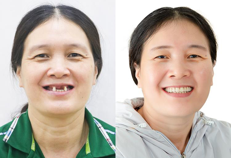 20 năm mất răng và hành trình tìm lại hạnh phúc nhờ trồng răng Implant - Ảnh 3. 20 năm mất răng và hành trình tìm lại hạnh phúc nhờ trồng răng Implant - Ảnh 3.
