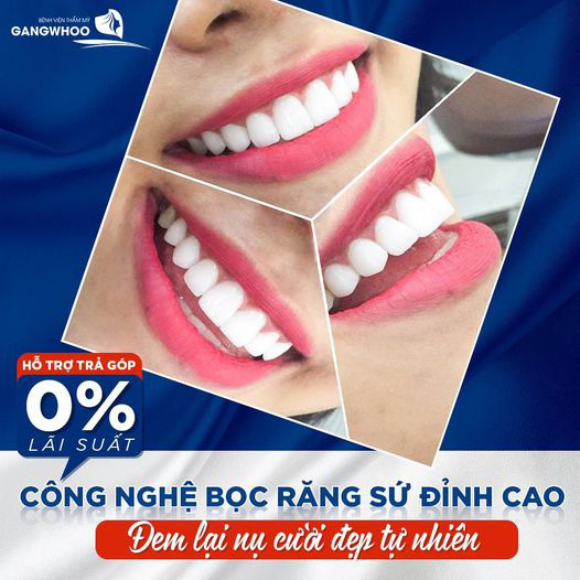 Bệnh viện thẩm mỹ Gangwhoo bọc răng sứ giúp loại bỏ mọi khuyết điểm về răng - Ảnh 3.