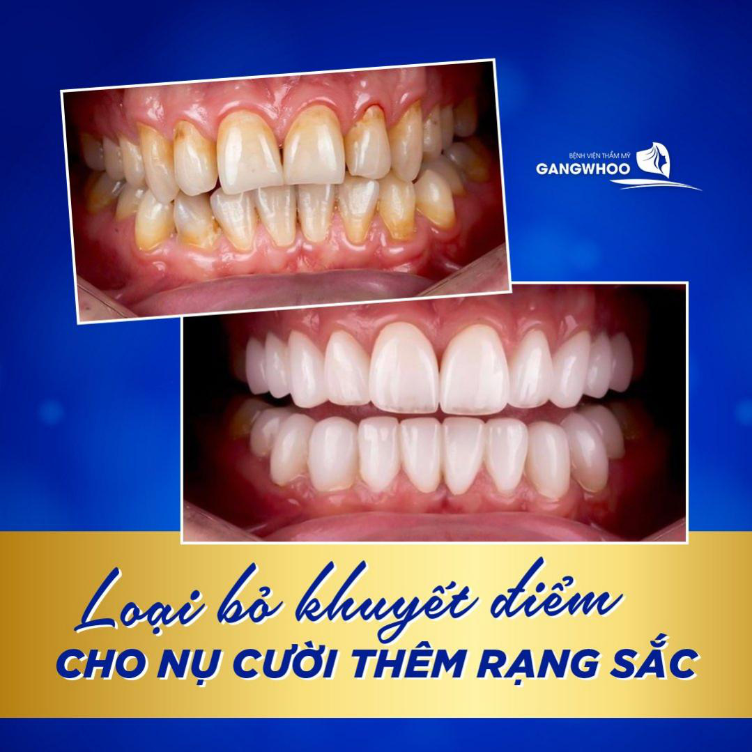 Bệnh viện thẩm mỹ Gangwhoo bọc răng sứ giúp loại bỏ mọi khuyết điểm về răng - Ảnh 4.