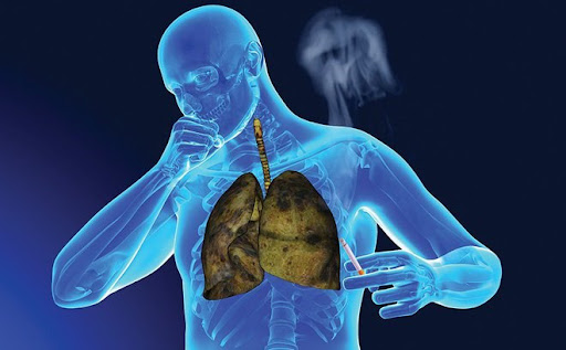 Ung thư phổi cực kỳ &quot;thích&quot; làm thân 5 kiểu người, kiểu thứ 5 ai nghe xong cũng thấy hãi - Ảnh 1.