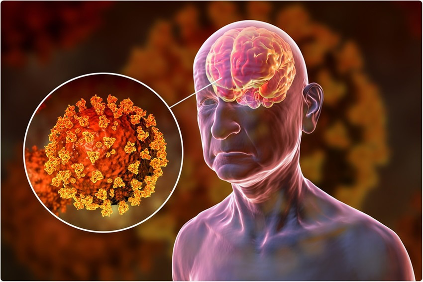 Phản ứng miễn dịch COVID-19 có thể ảnh hưởng đến não, gây ra các triệu chứng thần kinh - Ảnh 1.