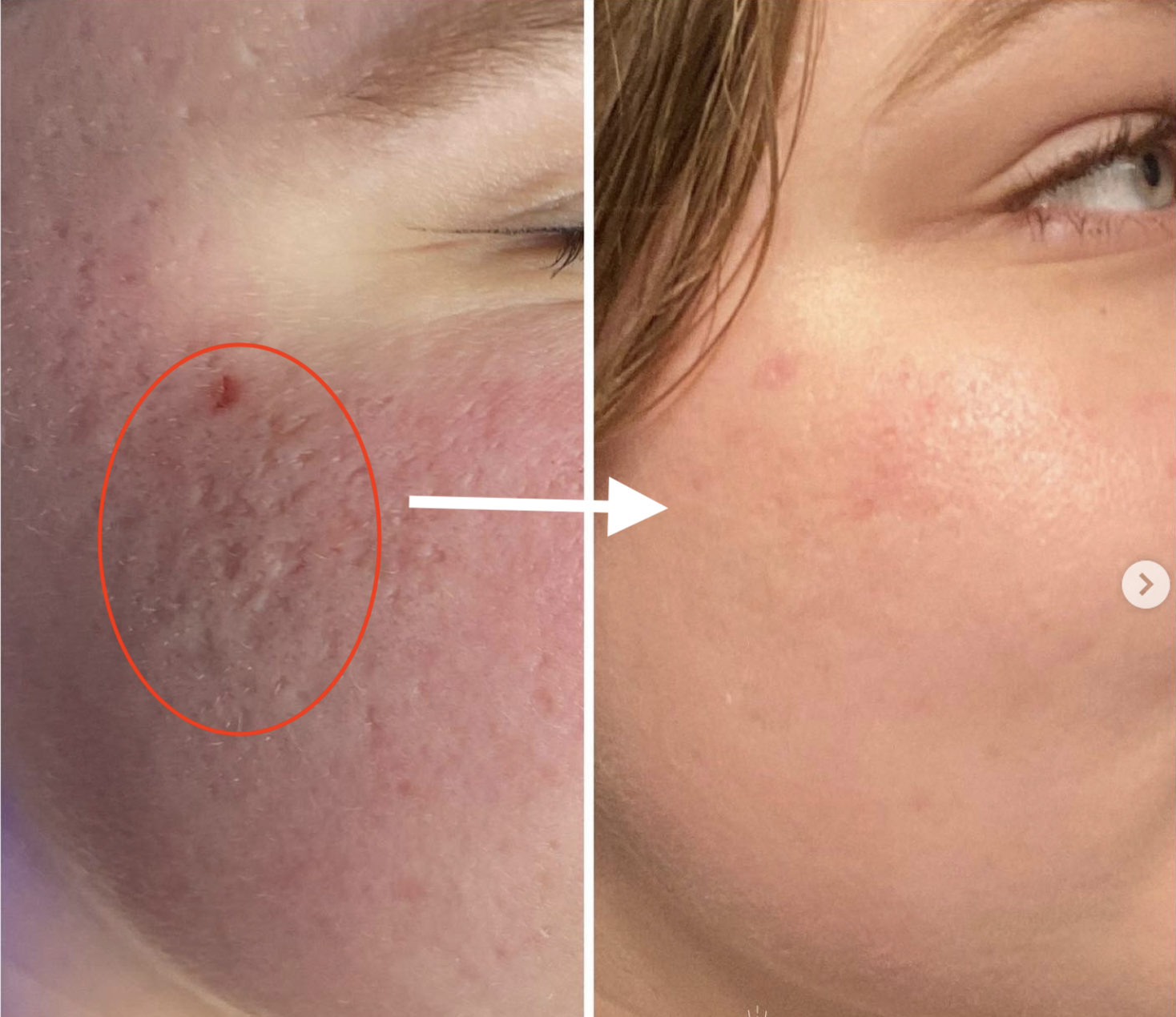 Tăng sinh collagen cho làn da theo lời khuyên của chuyên gia da liễu - Ảnh 4. Tăng sinh collagen cho làn da theo lời khuyên của chuyên gia da liễu - Ảnh 4.