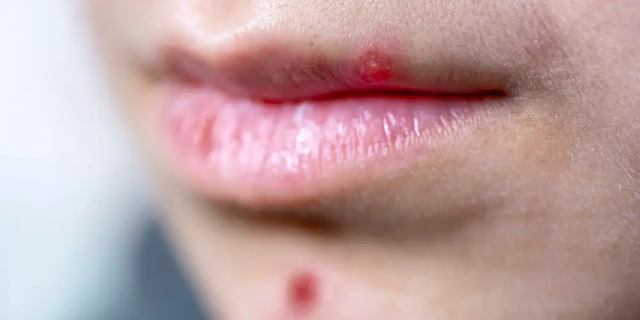 Nguyên nhân gây ra mụn quanh môi và cách giúp bạn có thể ngăn ngừa nó - Ảnh 3.