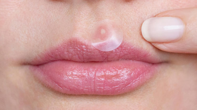 Nguyên nhân gây ra mụn quanh môi và cách giúp bạn có thể ngăn ngừa nó - Ảnh 2.
