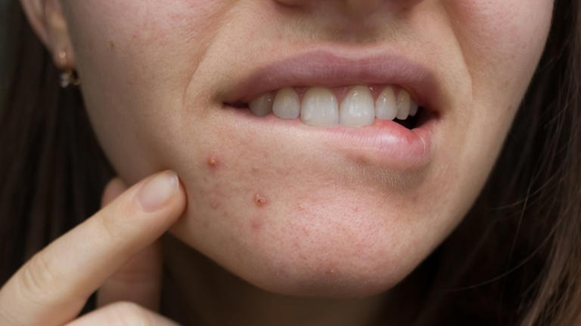 Nguyên nhân gây ra mụn quanh môi và cách giúp bạn có thể ngăn ngừa nó - Ảnh 1.