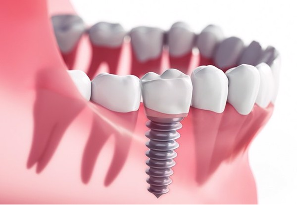 Cần lưu ý gì trước khi trồng răng Implant? - Ảnh 2.