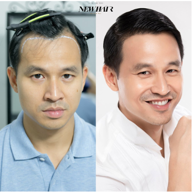 NEWHAIR by Khơ Thị cung cấp giải pháp công nghệ thẩm mỹ tóc khắc phục vĩnh viễn chứng hói đầu - Ảnh 2.