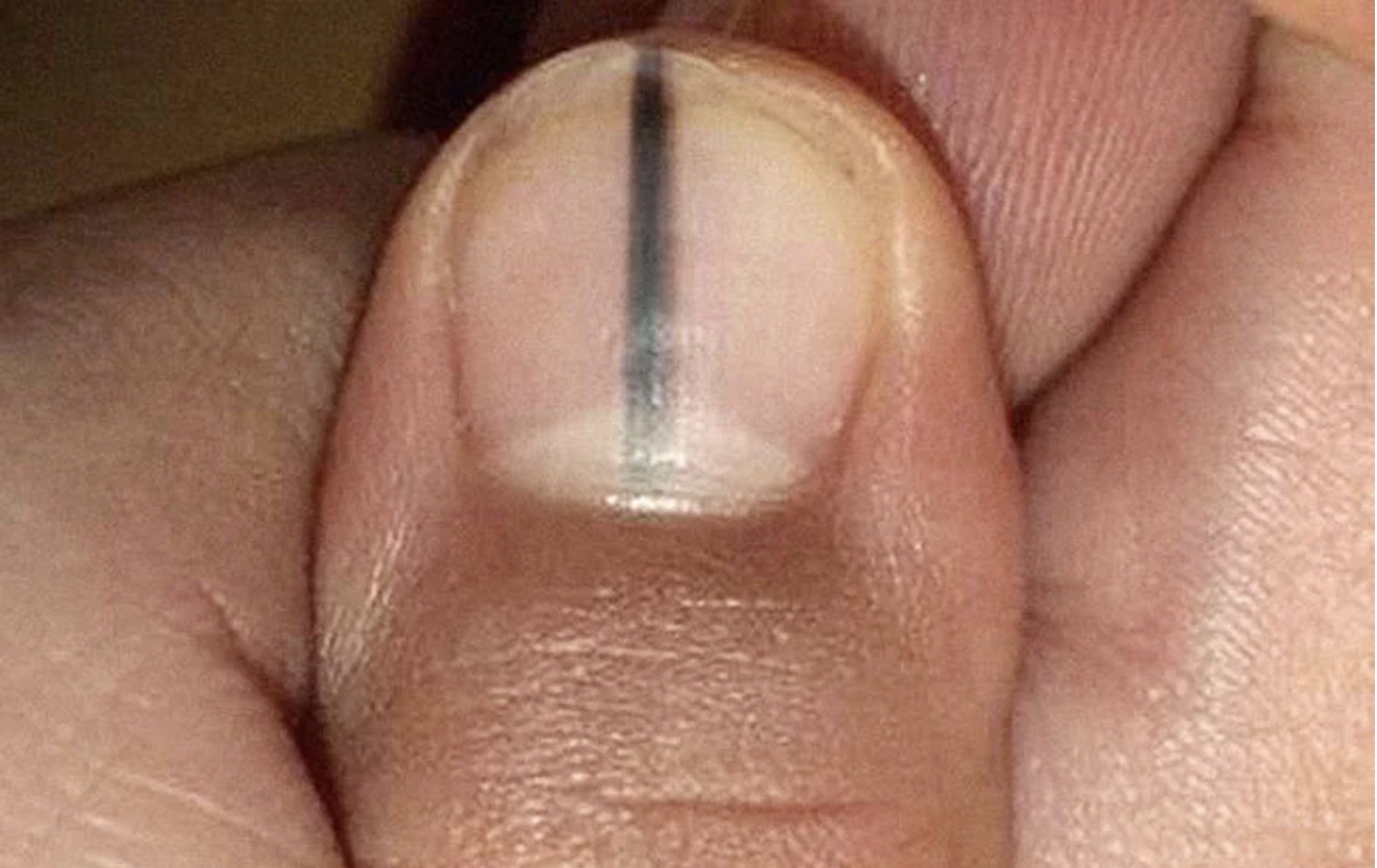 3 thay đổi này ở ngón tay có thể báo hiệu nhiều bệnh ung thư  - Ảnh 2.