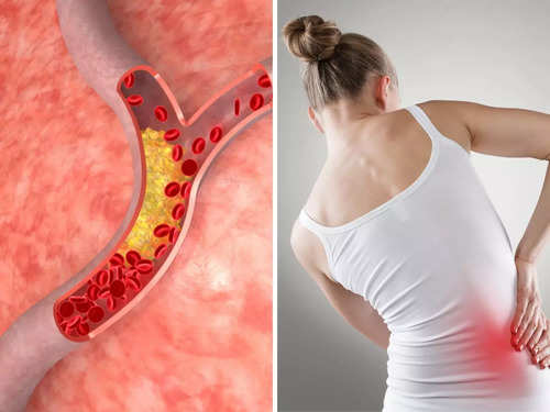 Dấu hiệu đầu tiên cảnh báo tình trạng cholesterol cao có thể làm tắc nghẽn động mạch của bạn - Ảnh 1.