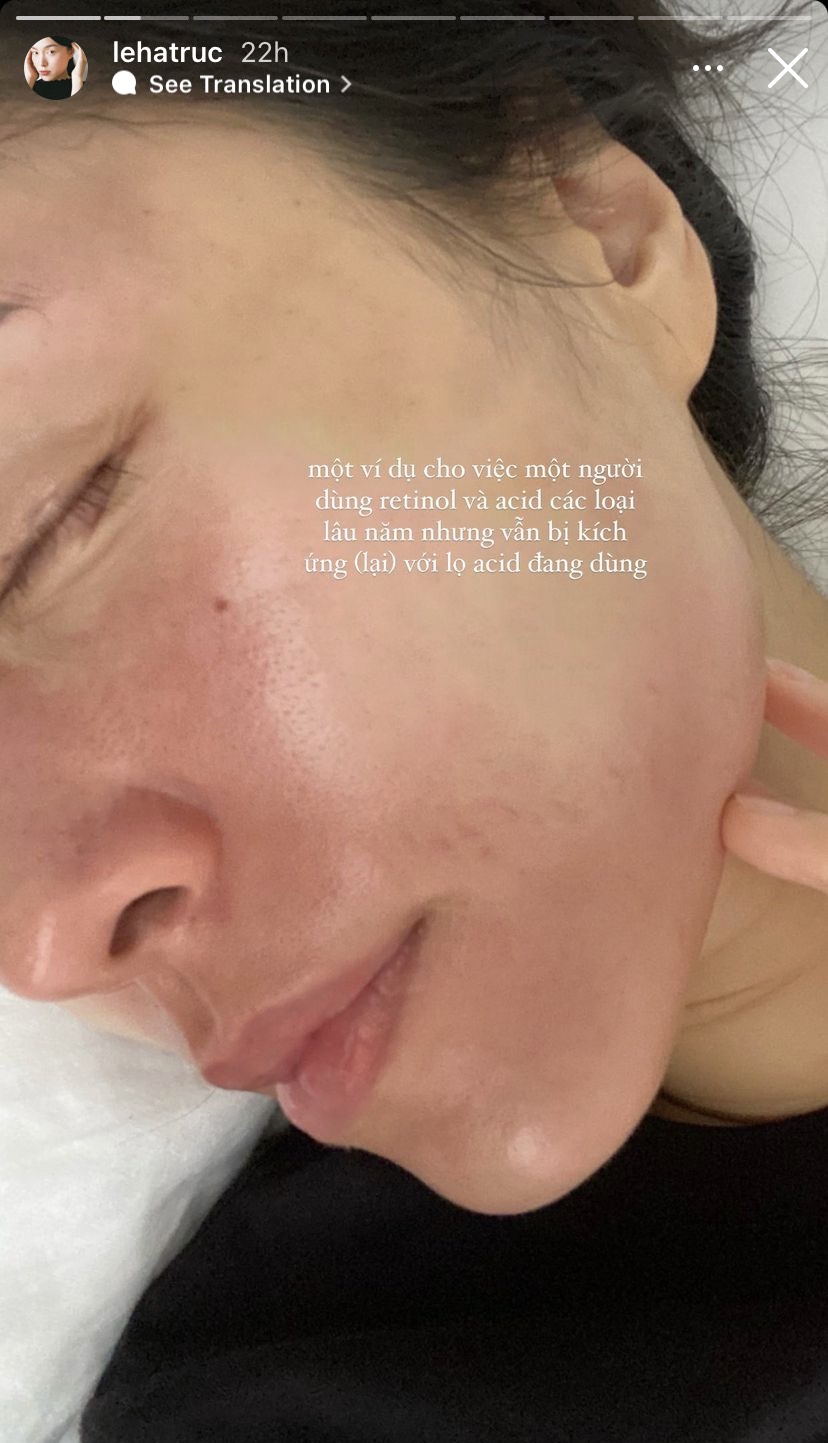 Dân chơi retinol và acid lâu năm như Hà Trúc mà còn bị kích ứng nặng, bạn mà mắc những lỗi này thì cũng toang thôi - Ảnh 2. Dân chơi retinol và acid lâu năm như Hà Trúc mà còn bị kích ứng nặng, bạn mà mắc những lỗi này thì cũng toang thôi - Ảnh 2.