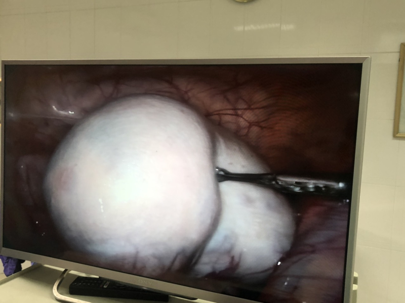 A 13-year-old girl with a large ovarian tumor, the doctor pointed out the consequences if not detected, early surgery - Photo 1.