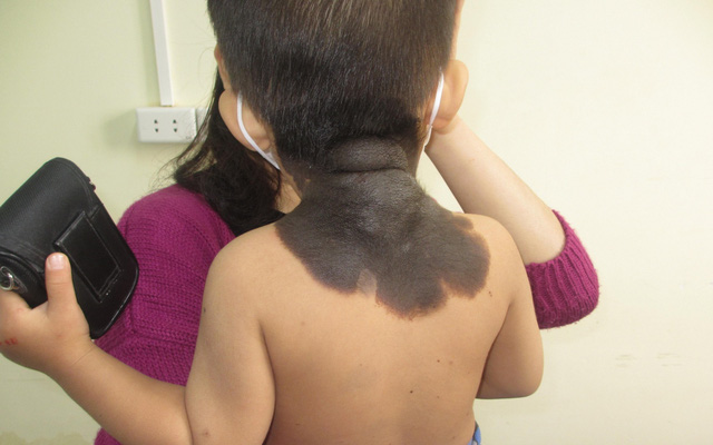 Phẫu thuật tạo hình cho bé trai 2 tuổi mắc hắc tố bẩm sinh khổng lồ vùng lưng, gáy - Ảnh 2.