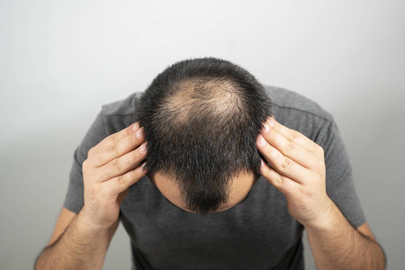 Nguyên nhân tóc rụng nhiều ở nam giới và cách điều trị