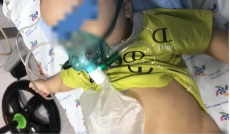 Saving the life of a 5-month-old baby with COVID-19 causing acute laryngitis, severe respiratory failure - Photo 1.