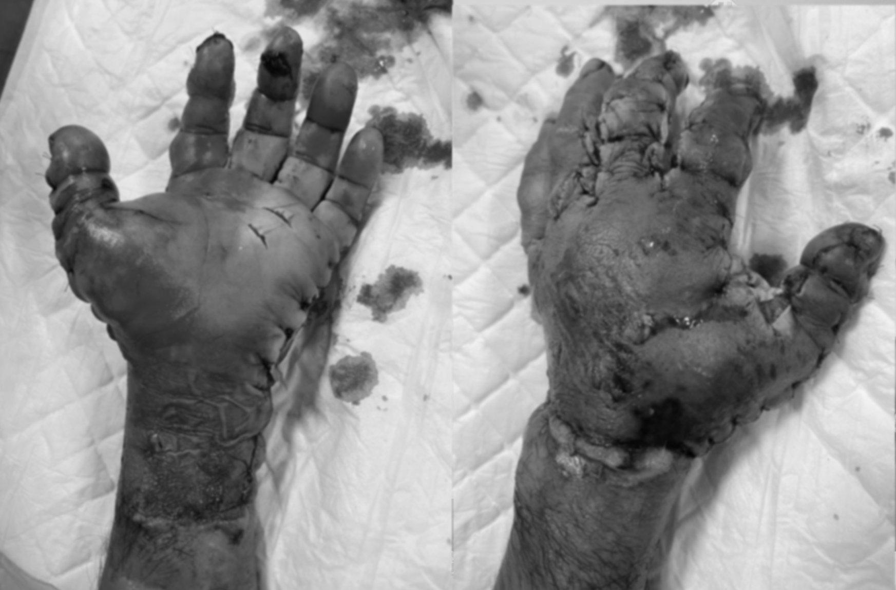 Bàn tay nhiễm trùng nặng sau 3 ngày bị máy bóc gỗ lóc da - Ảnh 2.