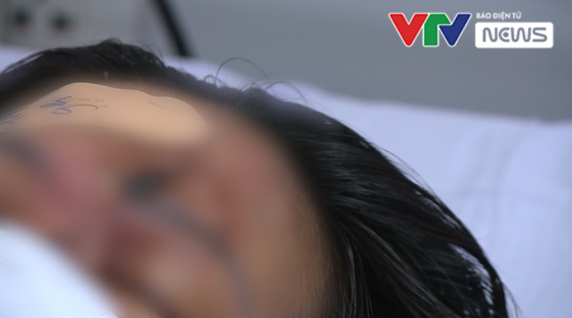 Một phụ nữ mù mắt sau khi tiêm filler nâng mũi tại spa - Ảnh 2.