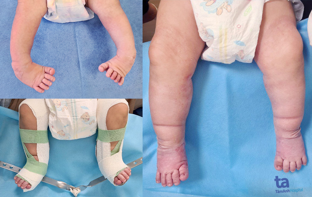 Điều trị bàn chân khoèo bẩm sinh cho bé sơ sinh - Ảnh 1. Điều trị bàn chân khoèo bẩm sinh cho bé sơ sinh - Ảnh 1.