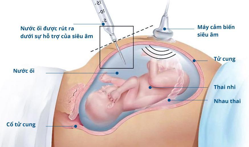 Để biết con có mắc hội chứng Down không, mẹ có thể làm những việc này - Ảnh 4.