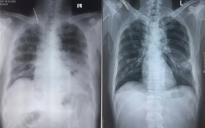 Hậu COVID-19: Bệnh nhân bị áp xe phổi, tràn khí màng phổi - Ảnh 1.