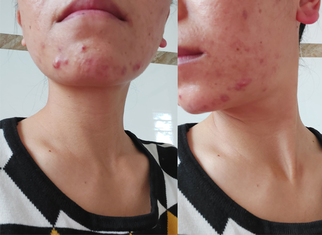 Face acne 10 years and many diseases, the woman 